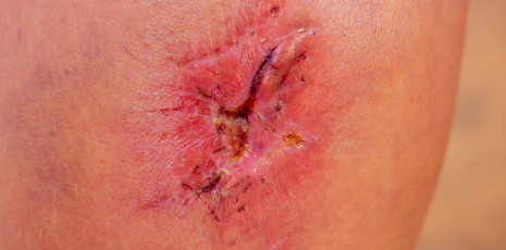 Les traitements homéopathiques en cas d’anthrax (évolution d’un furoncle)
