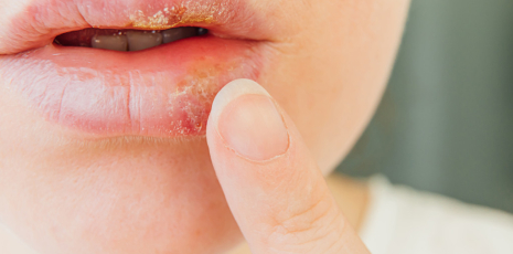 Soigner l'herpès labial et génital par l'homéopathie