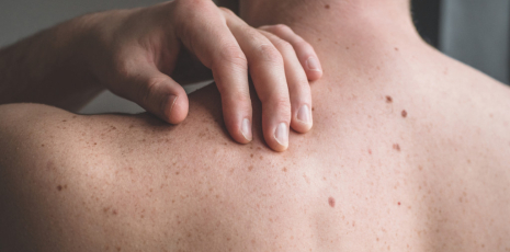 Remèdes homéopathiques pour soigner les pétéchies