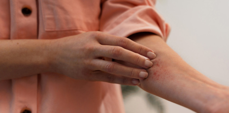 Soigner une mycose par un traitement homéopathique