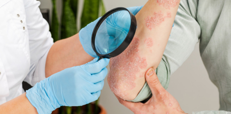 Comment traiter son psoriasis par l'homéopathie ?
