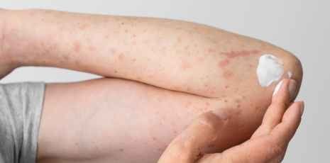 Remèdes homéopathiques pour soigner un purpura