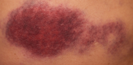 Radiodermites et homéopathie : quels tubes granules utiliser ?
