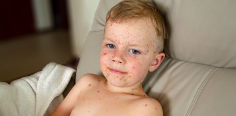 Traiter la varicelle par l'homéopathie